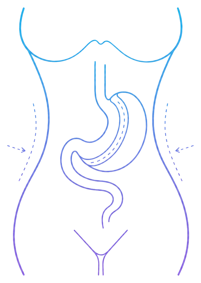 Bariatric Surgery