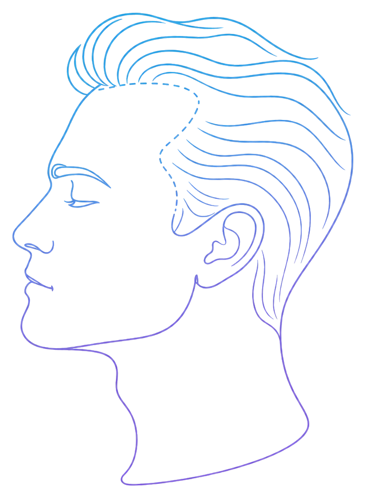 Hair Transplant